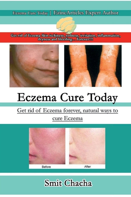 Eczema Cure Today - Get rid of Eczema forever natural ways to cure Eczema by Chacha, Smit